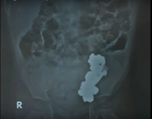 You'll never guess what doctors found in this toddler's stomach 