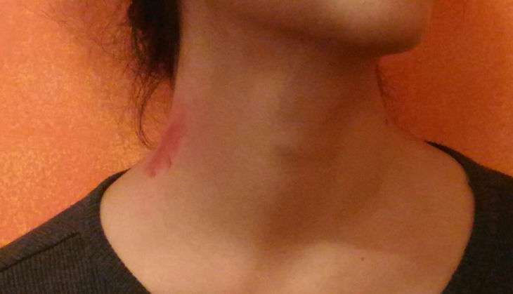 love bite hickey