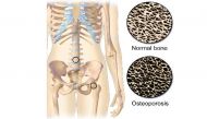 On International Osteoporosis Day, learn how to deal with the 'silent killer' 