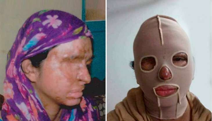 Acid attack victim