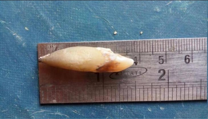 Worlds longest human tooth