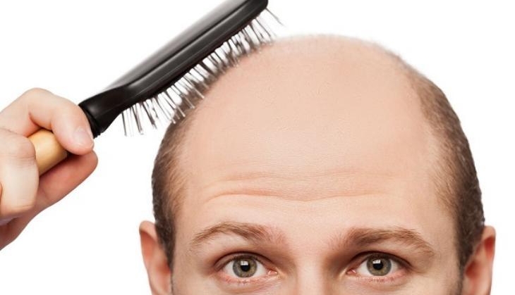 baldness