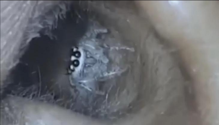 live_spider_crawls_out_of_women_ear