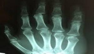 Removing old cells from joints can delay onset of osteoarthritis