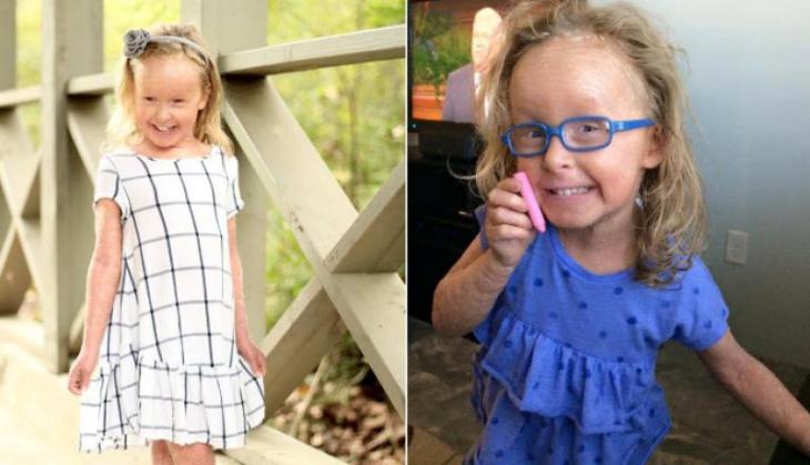 A six-year-old girl shed her skin like a snake