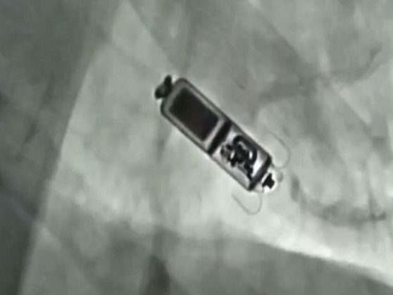 78-year-old receives world's smallest leadless pacemaker