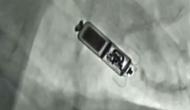 78-year-old receives world's smallest leadless pacemaker