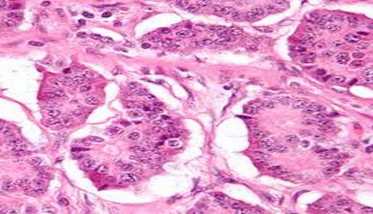Personalised molecular therapy slows progression of tumors