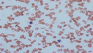 Now, it's easier to blunt sickle cell disease