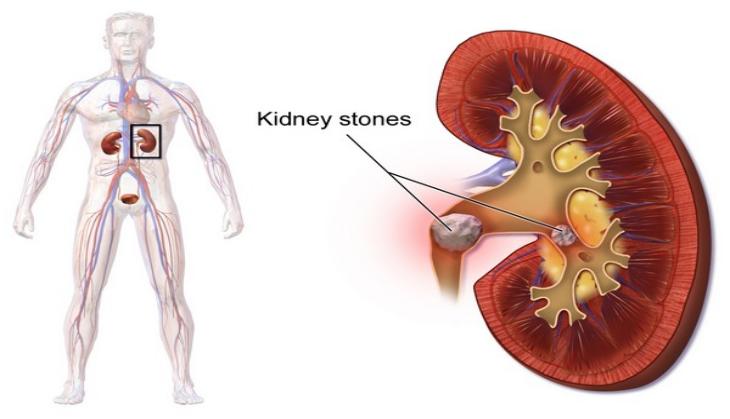 Looking for stone removal procedure?