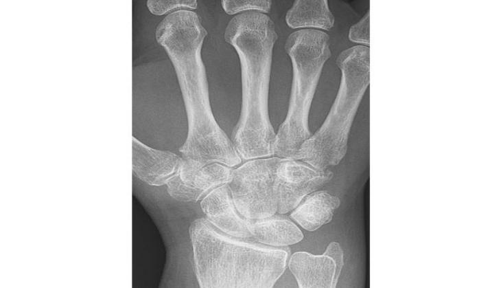 Untreated polyarthritis can deform joints permanently