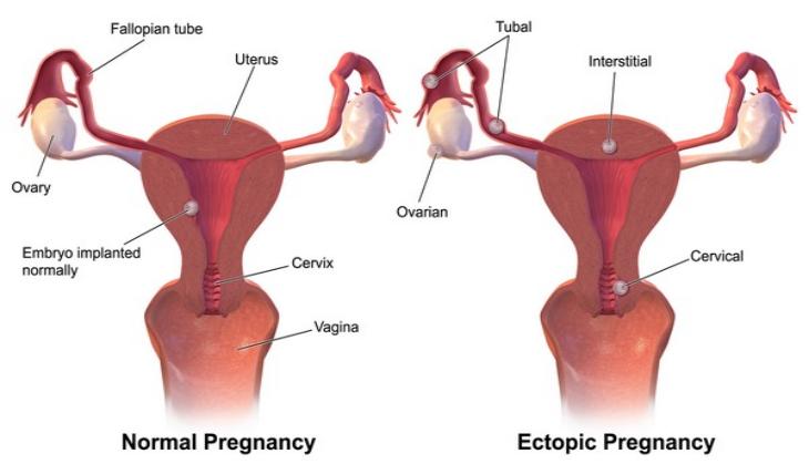Ectopic- A life threatening pregnancy