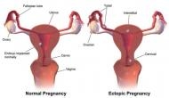 Ectopic- A life threatening pregnancy