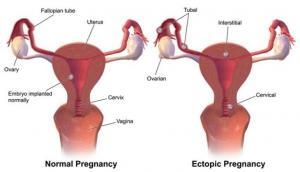 Ectopic- A life threatening pregnancy