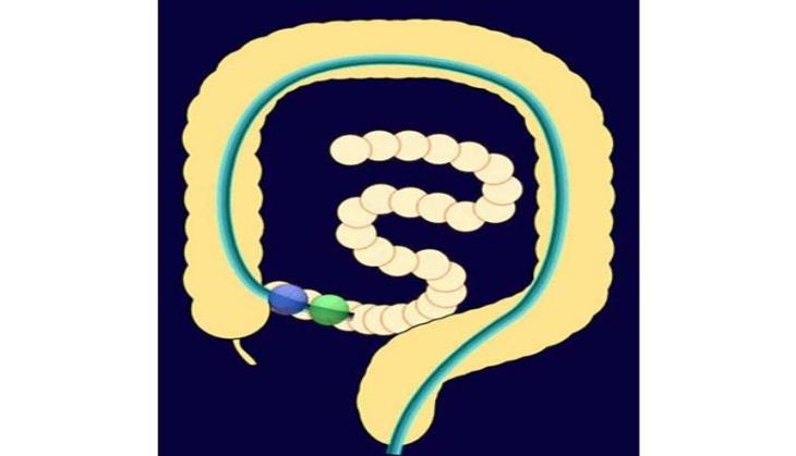 Double Balloon Enteroscopy: New introduction at BGS Gleneagles Global Hospitals