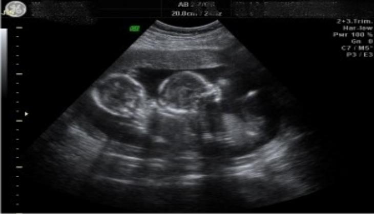 India witness a rarest of rare case 'fetus-in-fetu' after baby's birth