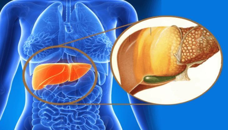 fatty liver