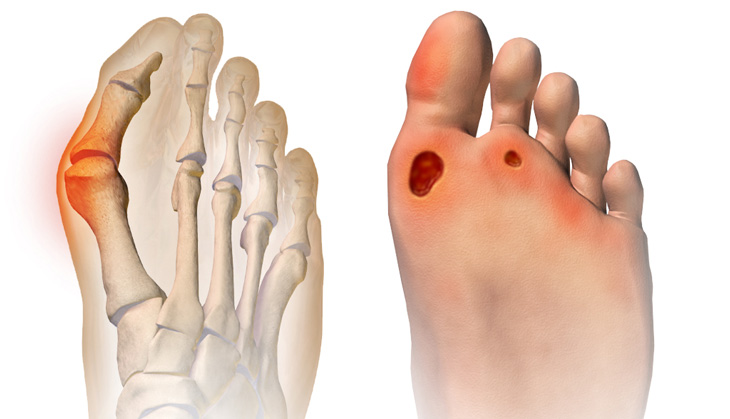 Explainer: what is a bunion and do I need to get mine treated?