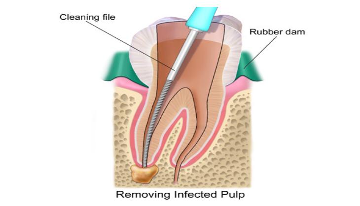 This gel can improve root canal results
