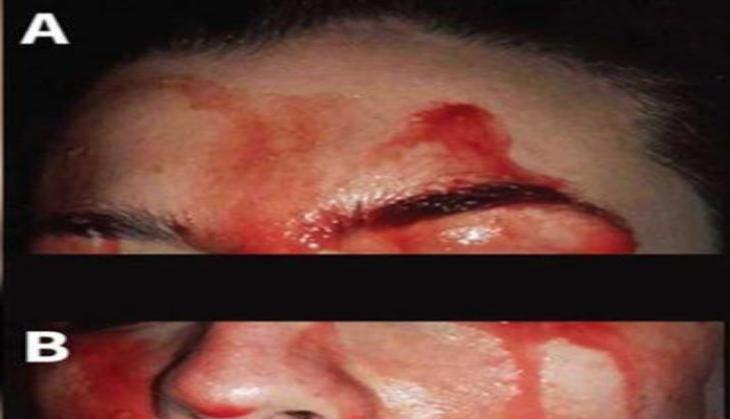 blood sweating