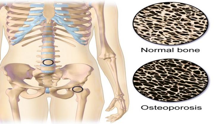 Air pollution causes weak bones, fractures
