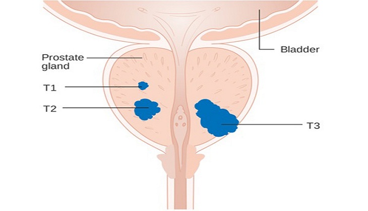 Finding blood in your urine could be early sign of prostate cancer