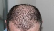 Early baldness, greying of hair ups heart disease risk in men