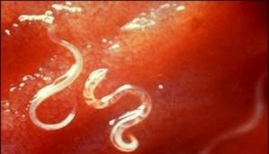 Shocking! Hookworms suck 22 litres of blood from a 14-year-old boy's small intestine
