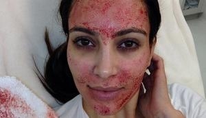 The latest fad in the beauty world - Vampire Facial