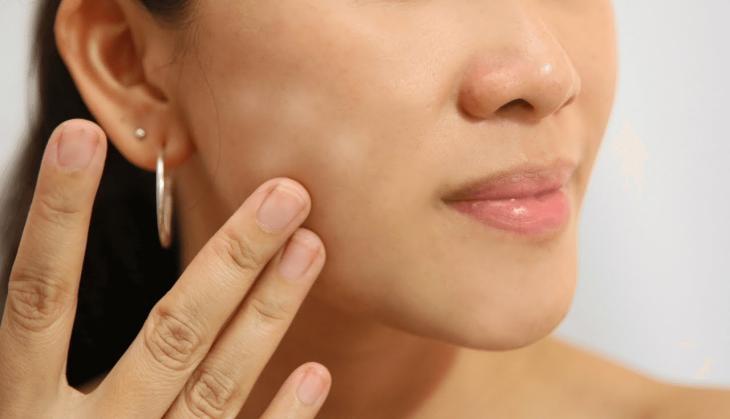 white spots on face