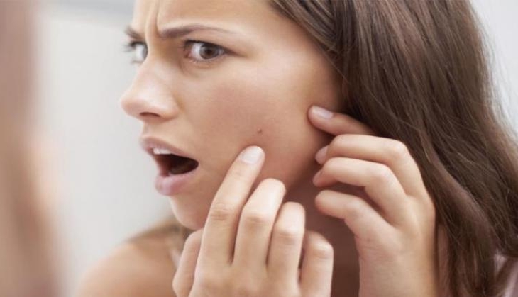Tips to remove your pimples