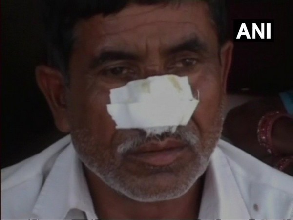 Bizarre! Man bites off brother's nose for money 