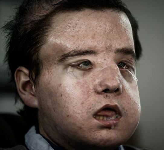 Face Off-2: French man undergoes second face transplant in medical history's first such case 
