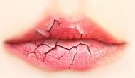 Alert! Follow these simple ways to protect your lips during summer
