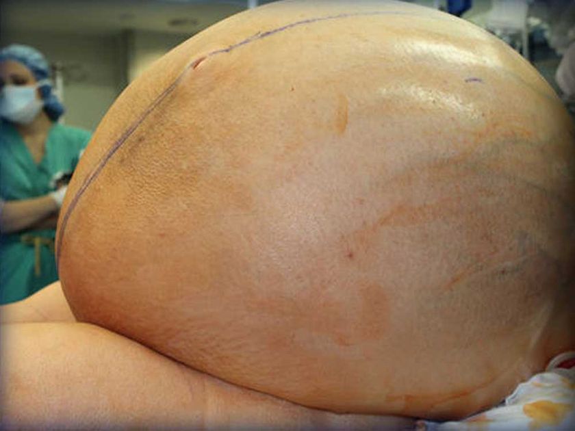 60 kg ovarian tumour removed from US woman