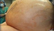 60 kg ovarian tumour removed from US woman