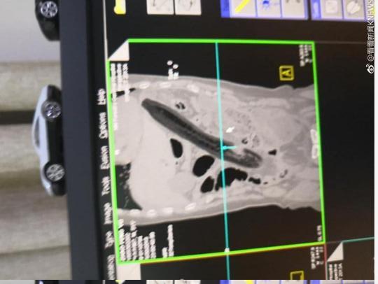 Shocking! Man in China inserted something unbelievable in his Anus to treat constipation that caused damage to his lungs; see pictures