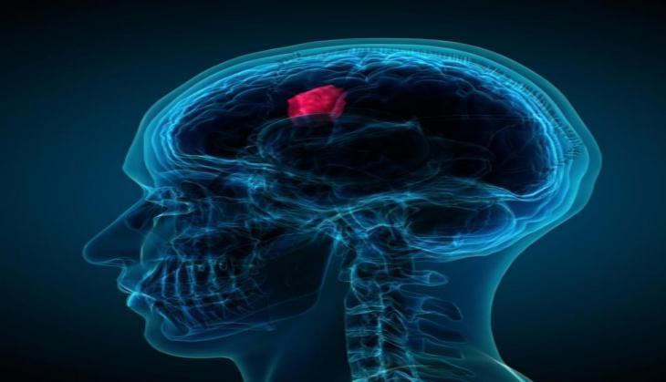 brain cancer