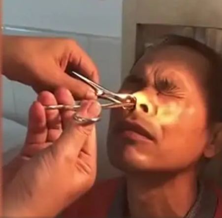 Horrifying Video: Blood-sucking leech extracted from man's nose