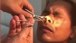 Horrifying Video: Blood-sucking leech extracted from man's nose