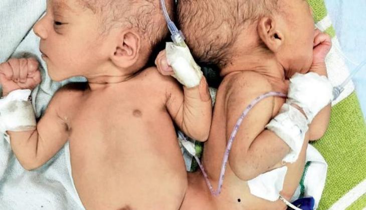 Conjoined Twin Girls