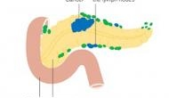 Blocking digestive hormone prevents pancreatic cancer