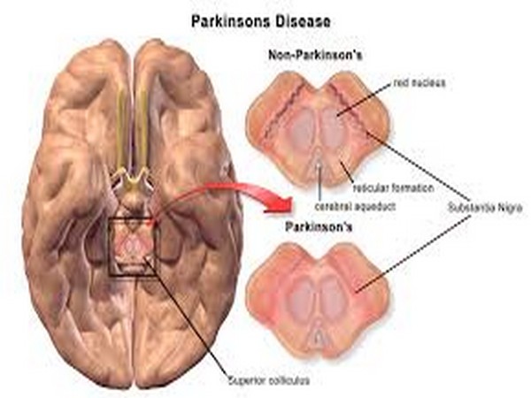 Insulin resistance may go undetected in non-diabetics with Parkinson's