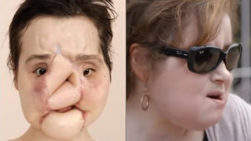 Face transplant: 21-Year-Old girl from United States gets new life after shooting herself in the face