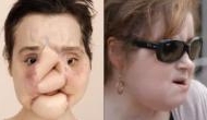 Face transplant: 21-Year-Old girl from United States gets new life after shooting herself in the face