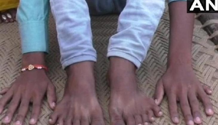 boy with 12 fingers and 12 toes