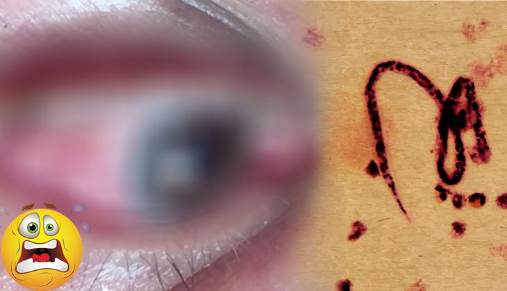 OMG! Doctor removes a large parasitic worm from man’s eyes; what happened next will give you goosebumps!