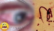 OMG! Doctor removes a large parasitic worm from man’s eyes; what happened next will give you goosebumps!
