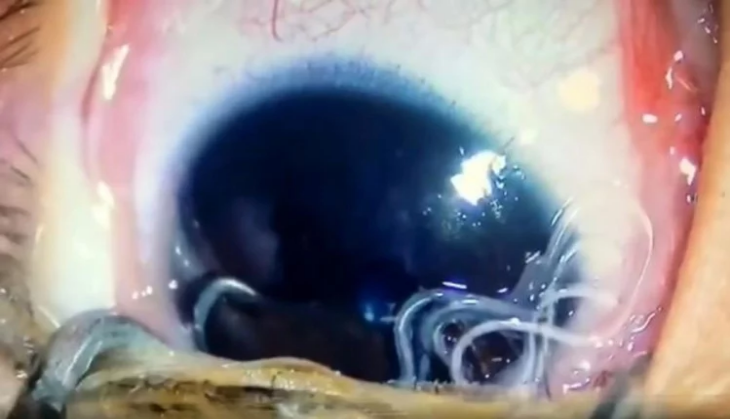 baby eye