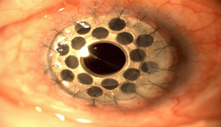 Weird! This woman has 500 holes in her eyes and the reason will give you goosebumps!